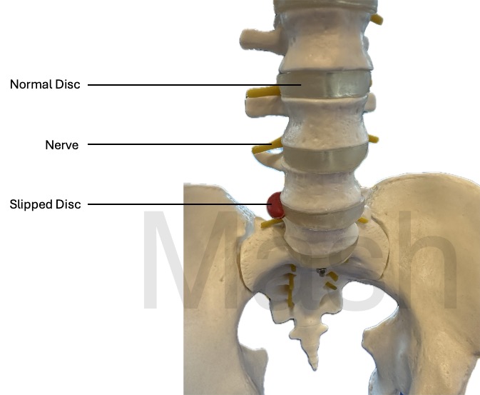 Slipped Disc